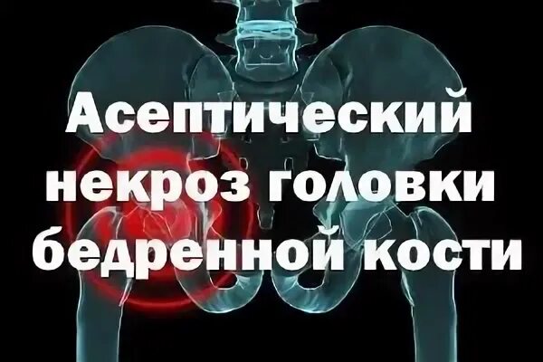 Некроз суставов лечение. Асептический некроз головок бедренных костей. асептический некроз головки тазобедренного. асептический некроз головки бедренной кости стадии. асептический некроз тазобедренного сустава.