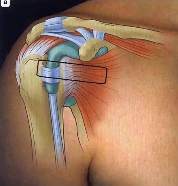 Повреждение сухожилия подлопаточной мышцы. Субдельтовидный бурсит. Сухожилие надостной мышцы анатомия. Подлопаточная синовиальная сумка. Сухожилие надостной мышцы плеча.
