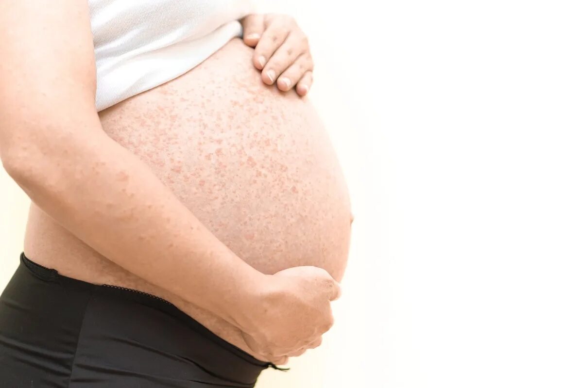 Во время беременности появляется. Атопический дерматит (дерматоз) беременных;. Краснуха при беременности. Дерматит на животе у беременной.