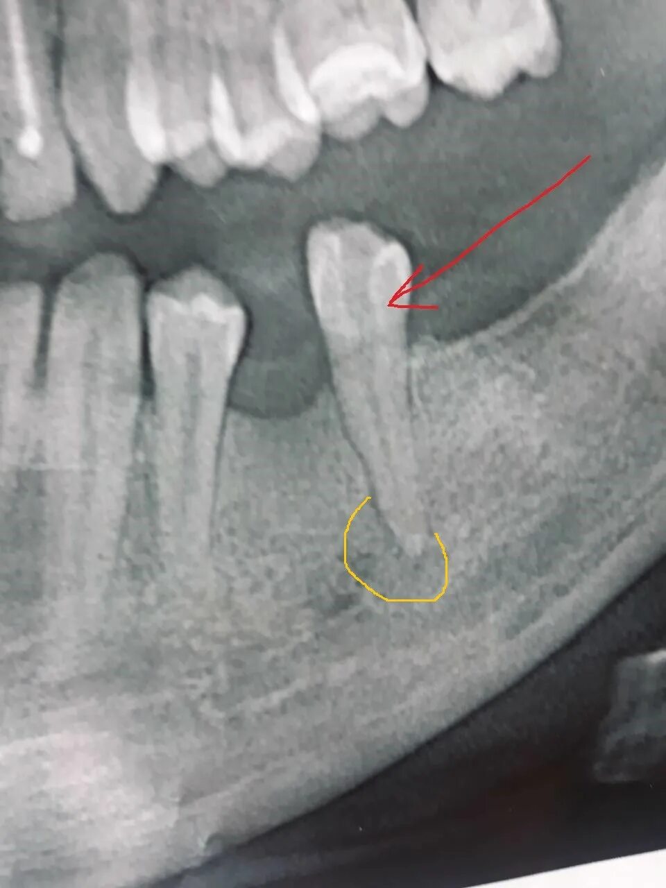 Корневая (радикулярная) киста. Киста корня зуба рентген. Удаление зуба семерки