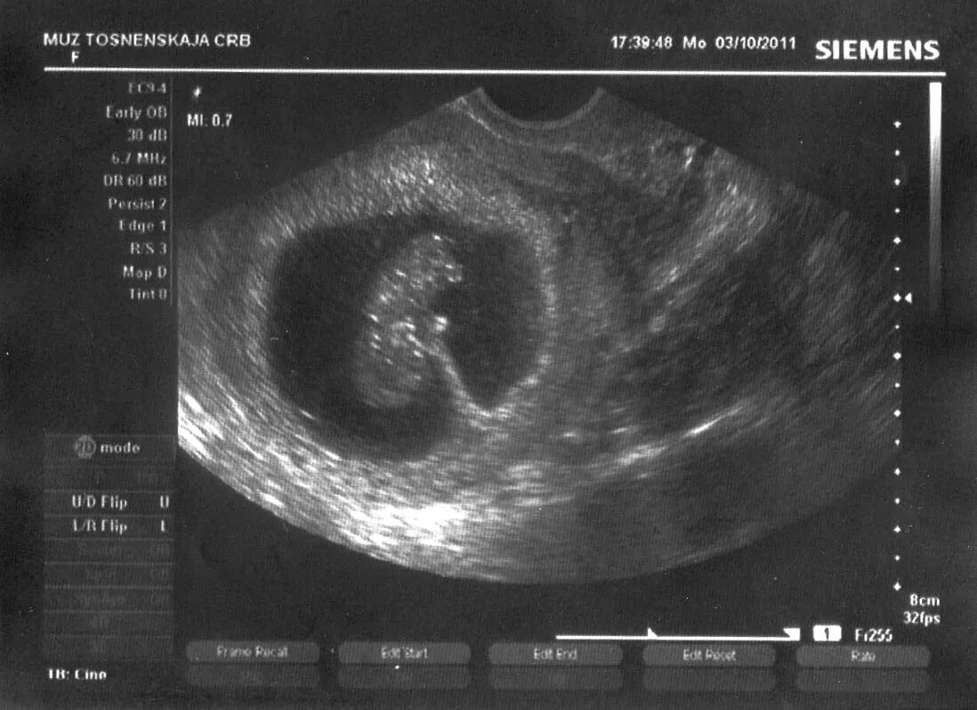 Узи эмбриона 7 недель. Снимок УЗИ на 7-8 неделе беременности. 6-8 Недель беременности УЗИ. УЗИ эмбрион 5 недель и 4 дня беременности. Беременность по неделям УЗИ 7 недель.