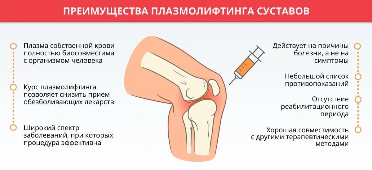 Процедура плазмолифтинга для суставов. Плазмотерапия суставов (PRP-терапия, плазмолифтинг). Плазмолифтинг PRP терапия коленного сустава. Введение плазмы в сустав. Плазмолифтинг для суставов колена.