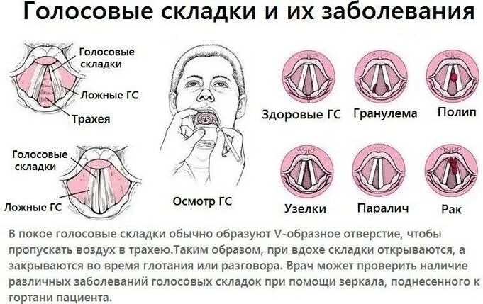 Положение голосовых связок при молчании почему. Парез голосовой складки. Голосовые связки ларингит. Узелки голосовых складок гортани. Ларингит голосовые складки.