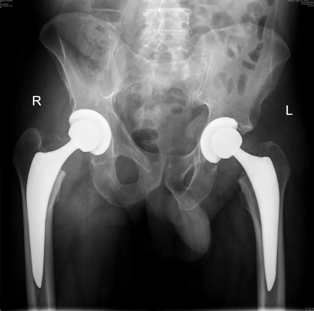 Операция по протезированию тазобедренного сустава. ТБС тазобедренного сустава. Швейцарский ТБС эндопротез тазобедренного сустава. Ревизионное эндопротезирование тазобедренного сустава.