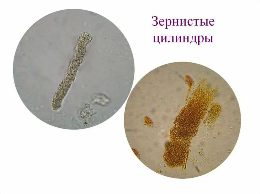 Моча цилиндры гиалиновые повышенные. Гиалиновые и зернистые цилиндры. Цилиндры гиалиновые зернистые восковидные. Гиалиновый цилиндр в моче микроскопия. Зернистые и восковидные цилиндры в моче.