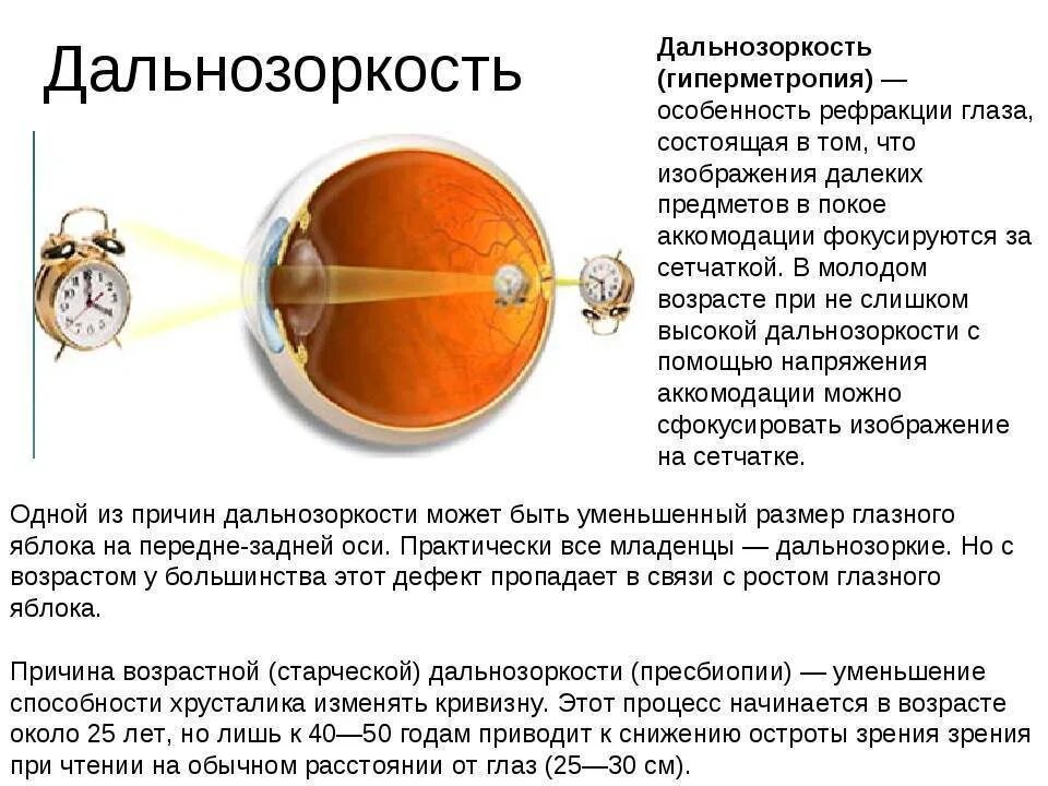 Болезнь дальнозоркость. Болезни глаз близорукость и дальнозоркость. Острота зрения близорукость и дальнозоркость. Диагноз: гиперметропия слабой степени. Пресбиопия. Гиперметропия 1 степени миопический астигматизм.