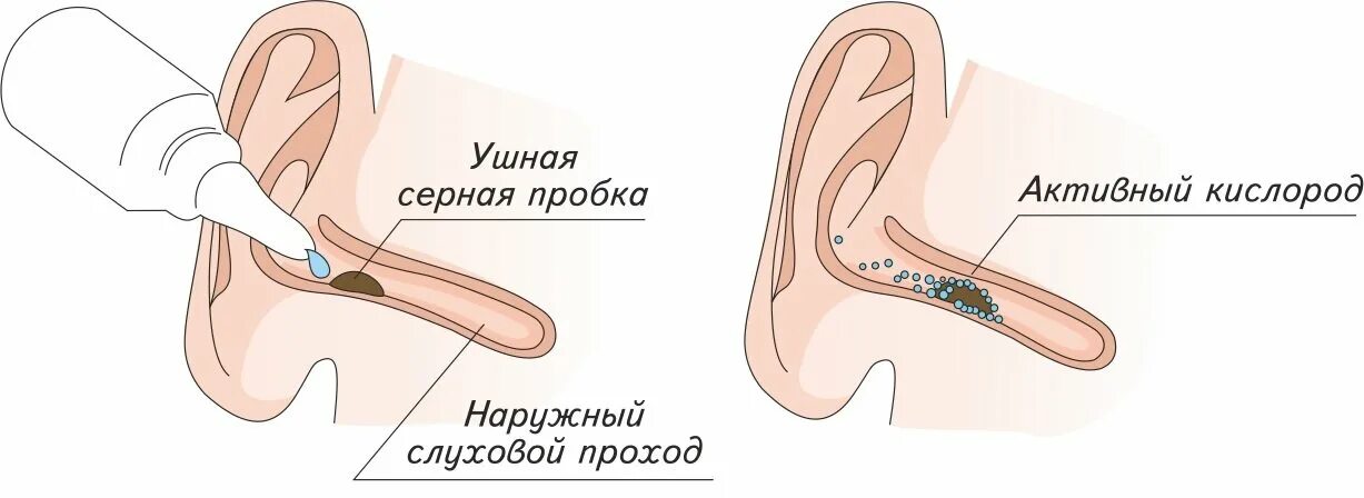 Как убрать пробку в ухе перекисью