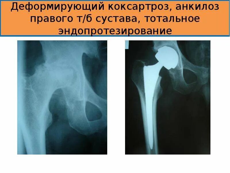 Что такое остеоартроз тазобедренного сустава 2. Что такое остеоартроз тазобедренного сустава 2