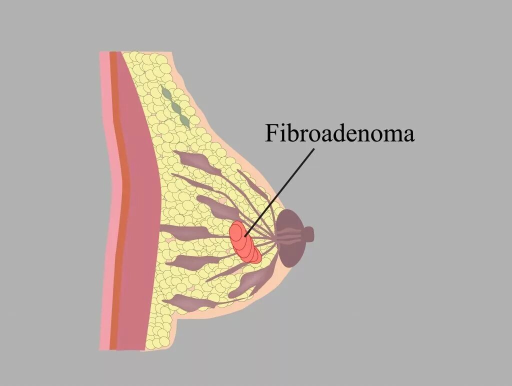 Фиброма в груди. Фиброматоз молочной железы. Фиброаденома в молочной железе. Фиброма в грудной железе.