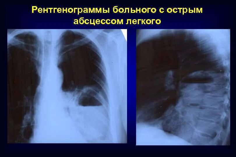 Абсцесс на рентгенограмме. Абсцесс легкого после вскрытия рентгенограмма. Абсцесс правого легкого рентгенограмма. Мокрота при абсцессе легкого