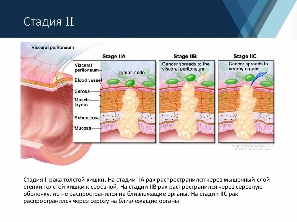 Стадии онкозаболевания. Онкология толстой кишки 2 стадия. Классификация опухоли прямой кишки TNM. Стадии опухоли толстой кишки. Онкология прямой кишки стадии