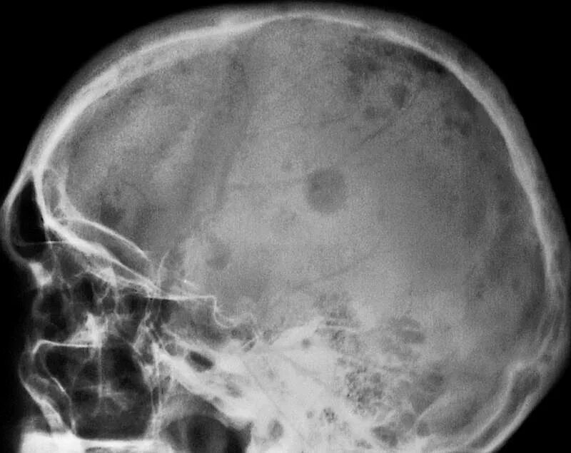 Кости черепа рентген. Миеломная болезнь рентген черепа. Миелома костей рентген. Плазмоцитома костей черепа.