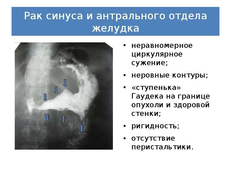 Новообразование в желудке. Ригидность стенок желудка. Эрозия антрального отдела. Новообразование желудка рентген. Диффузный антральный