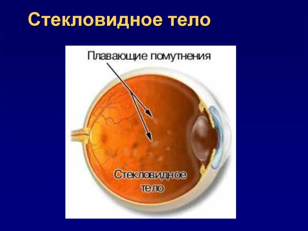Гемофтальм стекловидного тела. Деструкция стекловидного тела. Деструкция стекловидного тела глаз причина и лечение. Деструкция стекловидного тела кольцо вейса. Деструкция световмдного тела.