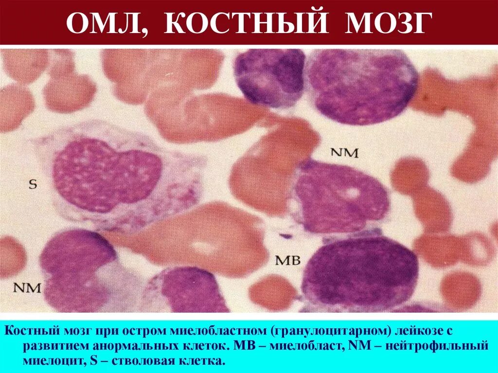 Мозг при остром лейкозе. Костный мозг при миелоидном лейкозе. Острый миелобластный лейкоз гистология. Хронический миелобластный лейкоз гистология. Миелоцитарный лейкоз гистология.