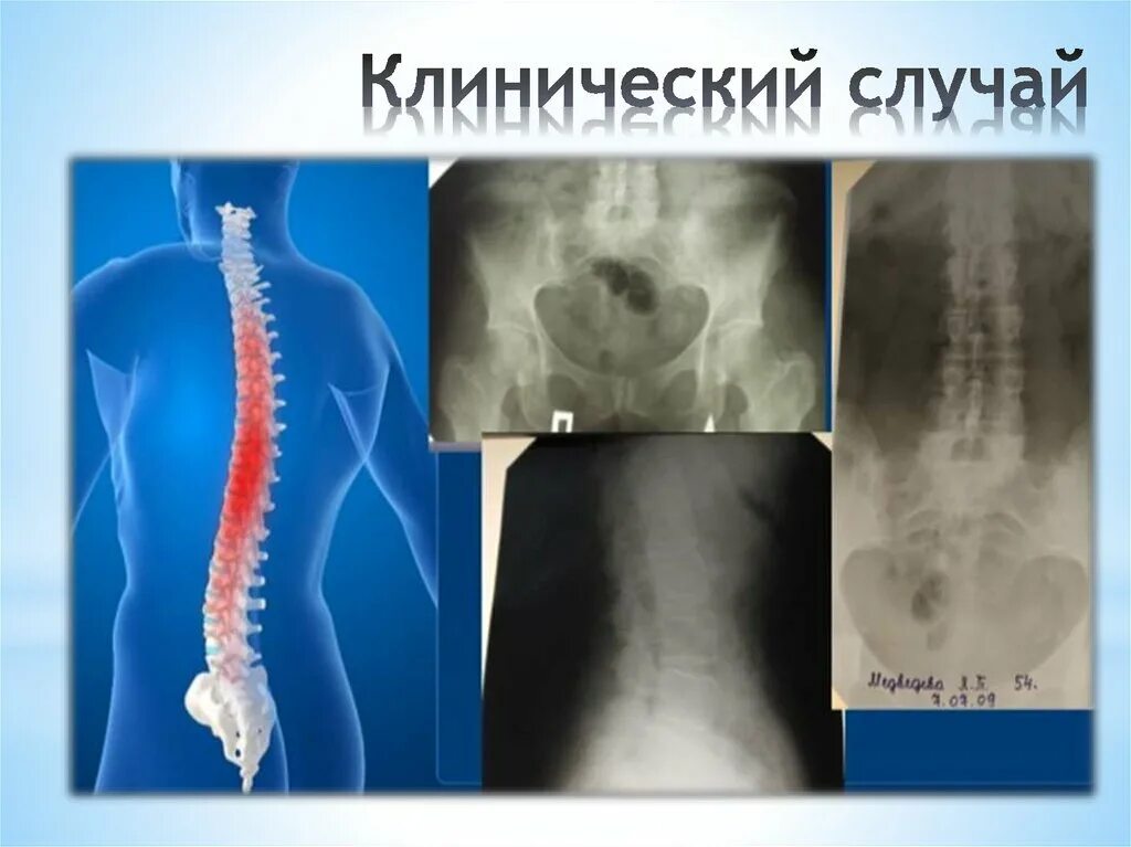 Бехтерева анкилозирующий спондилоартрит. Анкилозирующий спондилоартрит болезнь бехтерева. basfi анкилозирующий спондилит. анкилозирующий спондилит осложнения.