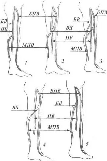 Суральные вены нижних конечностей ультразвуковая анатомия. Притоки мпв. Анатомия вен нижних конечностей схема. Анатомия подкожных вен нижних конечностей. Вена сафена магна анатомия.