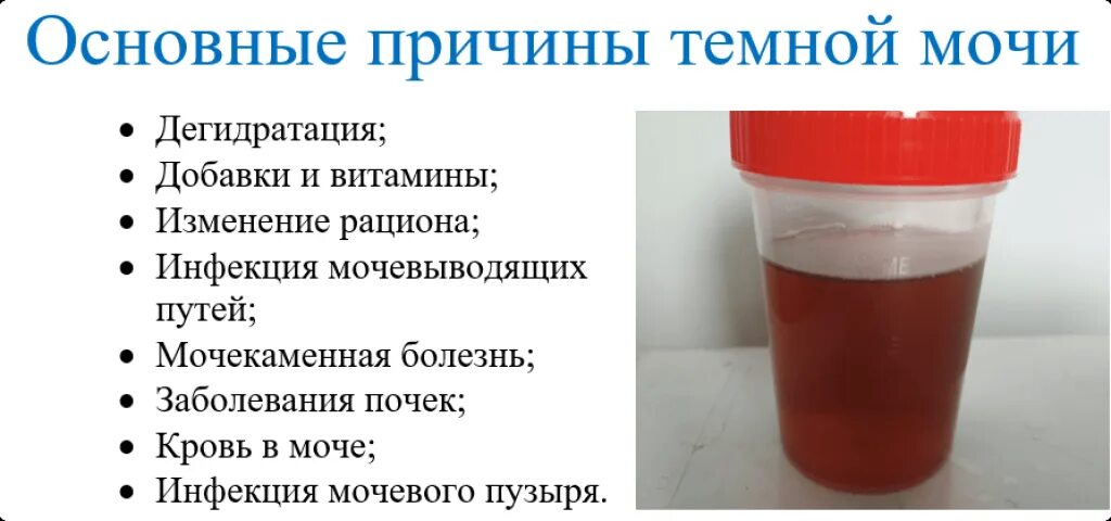 Почему моча красного цвета. Тёмная моча у мужчин причины. тёмная моча у женщин причины. тёмный цвет мочи у мужчин причины. моча красно-коричневого цвета.