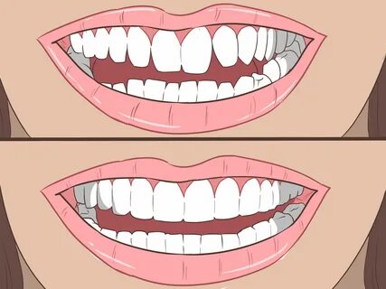 teeth straighten