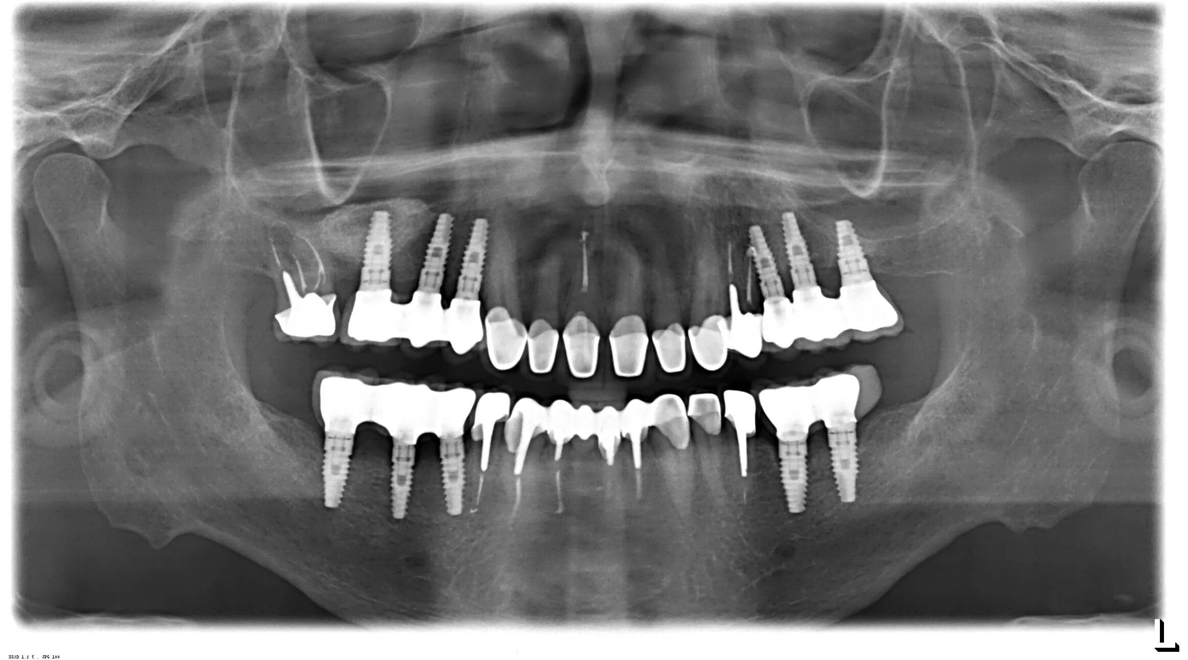 Снимок зубов видное. Ортопантомограмма (ОПТГ). Ортопантомограмма пародонтит. ОПТГ ортопантомограмма панорамный снимок.