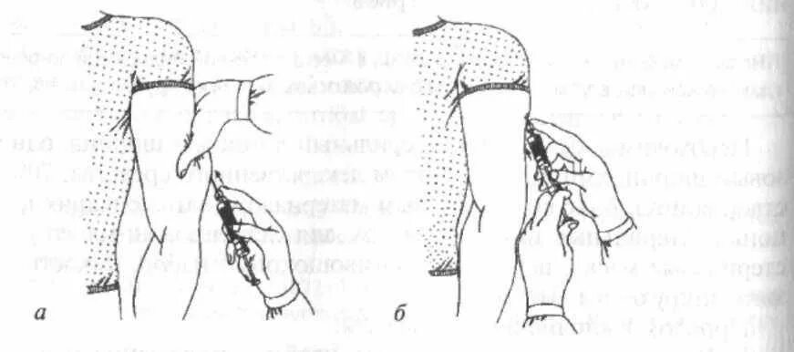 Подкожные инъекции техника выполнения. Внутрикожная инъекция алгоритм выполнения. Алгоритм введения инъекций подкожно. Алгоритм постановки подкожной инфекции. Алгоритм подкожной инъекции алгоритм.