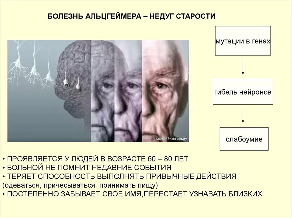 Болезнь Альцгеймера. Синдром Альцгеймера. Болезнь Альцгеймера больные. Синдромы болезни Альцгеймера. Наследственное заболевание мозга