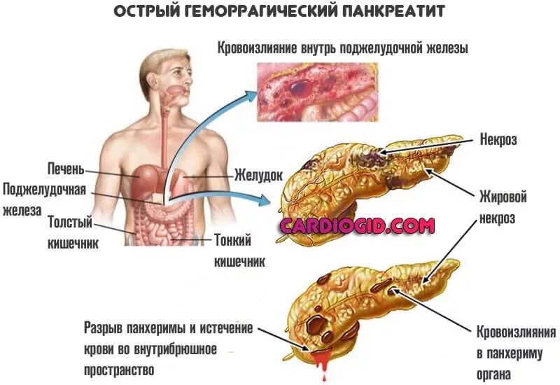 Как проявляется поджелудочная симптомы