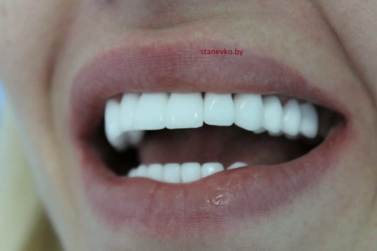 Керамометалическая коронка. Коронка металлокерамическая фарфоровая. Керамические коронки на передние зубы. Вставные керамические зубы. Как выглядят керамические зубы.