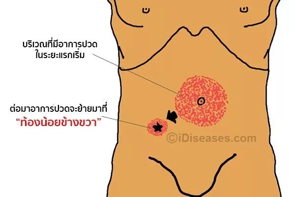 Точки аппендицита. Точка МАКБЕРНИ аппендицит. MCBURNEY точка аппендицита. Точка Ланца и Мак Бурнея.