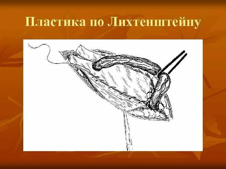 Лихтенштейн грыжесечения. Операция Лихтенштейна при паховой грыже схема. Операция Лихтенштейна герниопластика. Лихтенштейн операция паховая грыжа. Лихтенштейн операция паховая