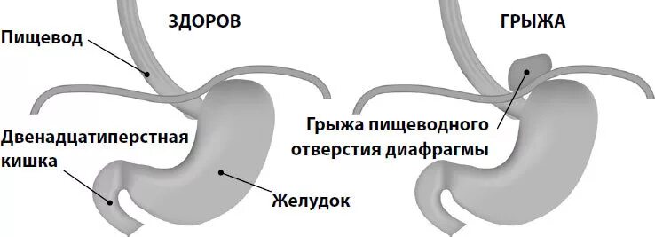 Диафрагмальный пищевода