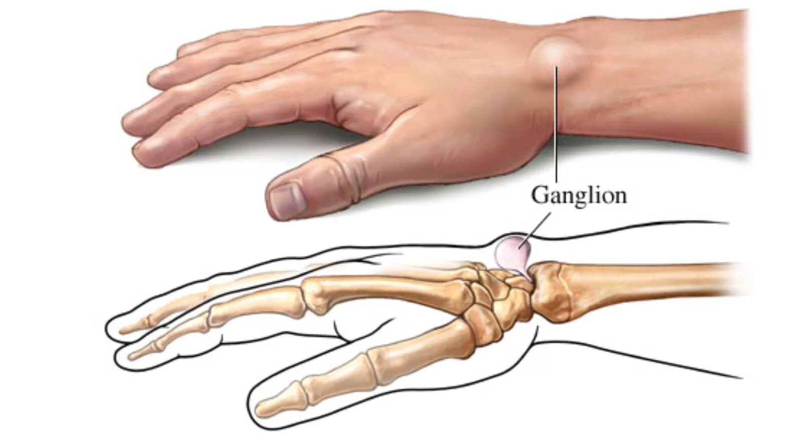 Почему на руках выходят. Гигрома сухожильный ганглий. Гигрома лучезапястного сустава. Ганглион лучезапястного сустава. Стенозирующий лигаментит.