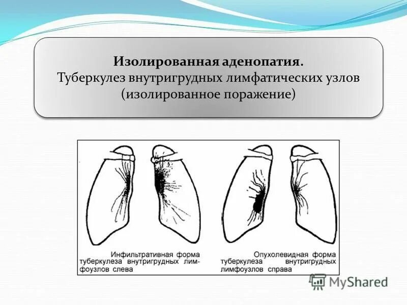 Формы туберкулеза внутригрудных лимфатических. Туберкулез внутригрудных лимфоузлов малая форма. Формы туберкулеза внутригрудных лимфатических узлов. Туберкулез внутригрудных узлов. Аденопатия