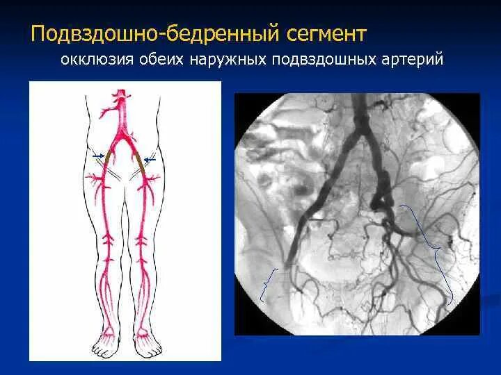 Подвздошно бедренная Вена. Подвздошная артерия. Подвздошная артерия нижних конечностей. Тромбоз подвздошной артерии. Артерии нижней конечности бедренная