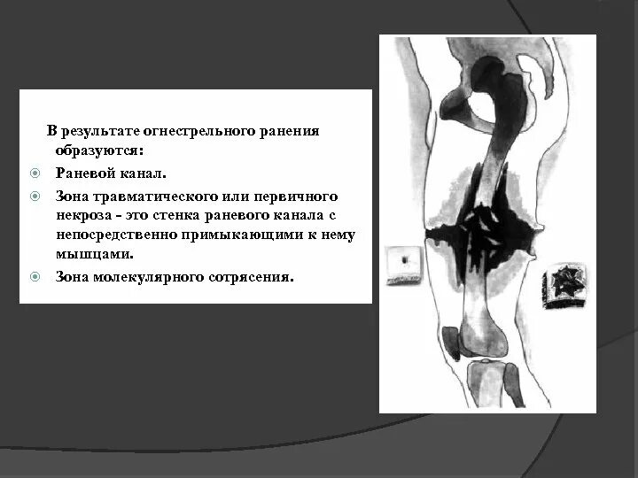 Зоны огнестрельного ранения. Зона первичного некроза при огнестрельном ранении. зоны повреждения огнестрельной раны. зоны повреждения при огнестрельной ране. раневой канал при огнестрельном ранении.