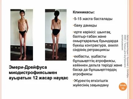 Мышечная дистрофия дрейфуса