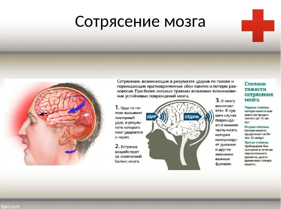 Сотрясения проходит. Сотрясение головы и головного мозга. Признаки сотрясения головного мозга. Признаки сотрясения головы.