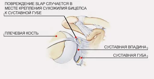 Разрыв суставной губы гленоида плечевого сустава. Повреждение фиброзно-хрящевой губы гленоида. Повреждения суставной губы гленоида лопатки. Повреждение суставной хрящевой губы гленоида. Разрыв губы гленоида