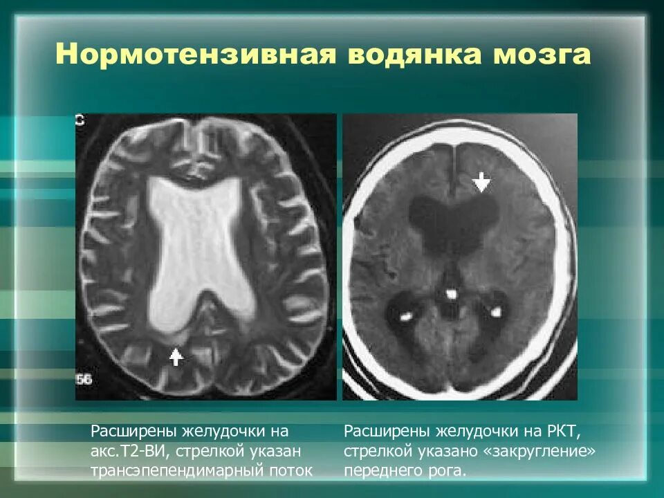 Расширение боковых рогов