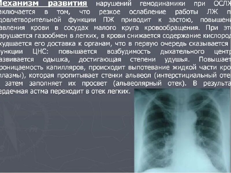 Отёк лёгких рентген описание. Альвеолярный ОТК легкого рентген. Отек легких рентген описание. Отек легких на рентгенограмме. Застой в легких у пожилых