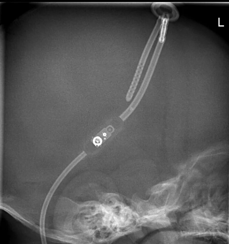 вентрикуло перитонеальный шунт рентген. схема шунтирования резистором. программируемый вентрикулоперитонеальный шунт. вентрикулярное шунтирование головного мозга. вентрикулоперитонеальный шунт медтроник.