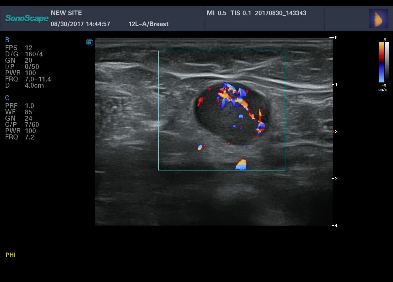Аваскулярное образование в печени. УЗИ молочных желез цветовое допплеровское картирование. ЦДК УЗИ молочных желез. Анэхогенное аваскулярное образование в молочной железе.