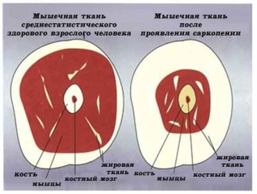 Саркопения у пожилых лечение отзывы. Саркопения. Мышечная саркопения. Старческая саркопения. Саркопения причины.