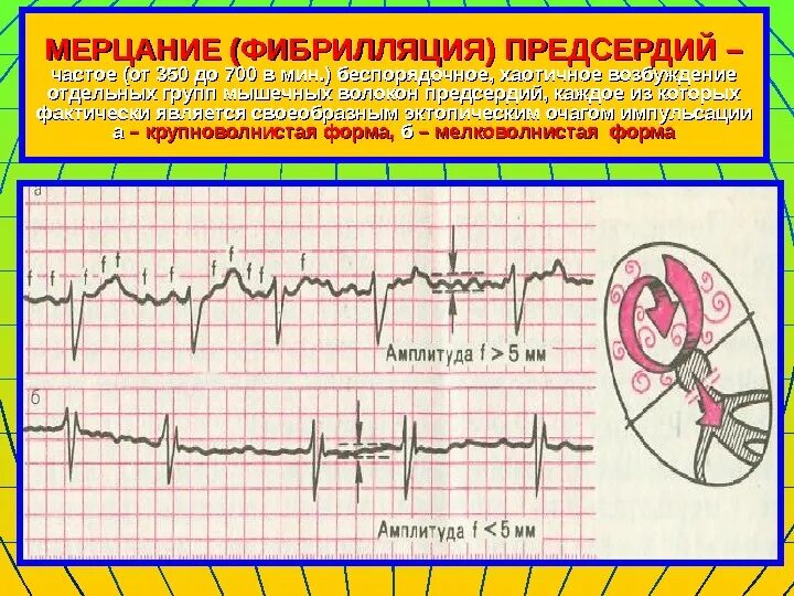Фибрилляция мышц. Трепетание фибрилляция и мерцание. фибрилляция и мерцание предсердий. мерцание фибрилляция и трепетание предсердий. мерцание и трение предсердий.