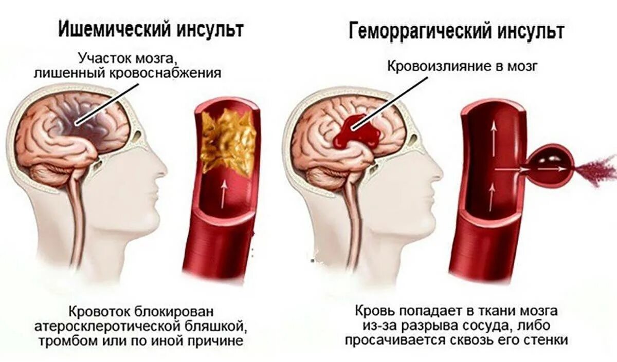 Микроинсульт больница. Геморрагический инсульт и ишемический инсульт. Различия геморрагического и ишемического инсульта. Ишемический и геморрагический инсульт отличия. Ишемия и геморрагический инсульт.