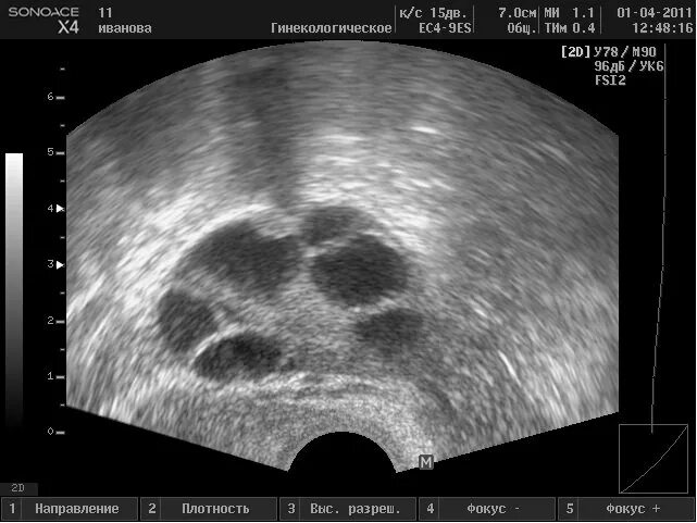 Узи овуляции форум. УЗИ мониторинг фолликулов. УЗИ мониторинг созревания фолликула. Преовуляторный фолликул на УЗИ.