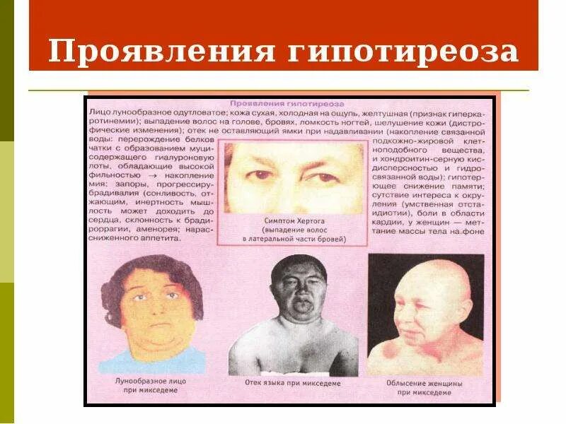 Как проявляется гипотиреоз. Как проявляется гипотиреоз