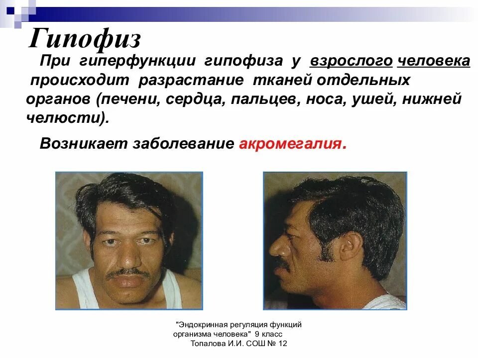 Гиперфункция гипофиза приводит. При гиперфункции гипофиза. гиперфункция гипофиза болезнь. заболевания при гиперфункции гипофиза. нарушения при гиперфункции гипофиза.
