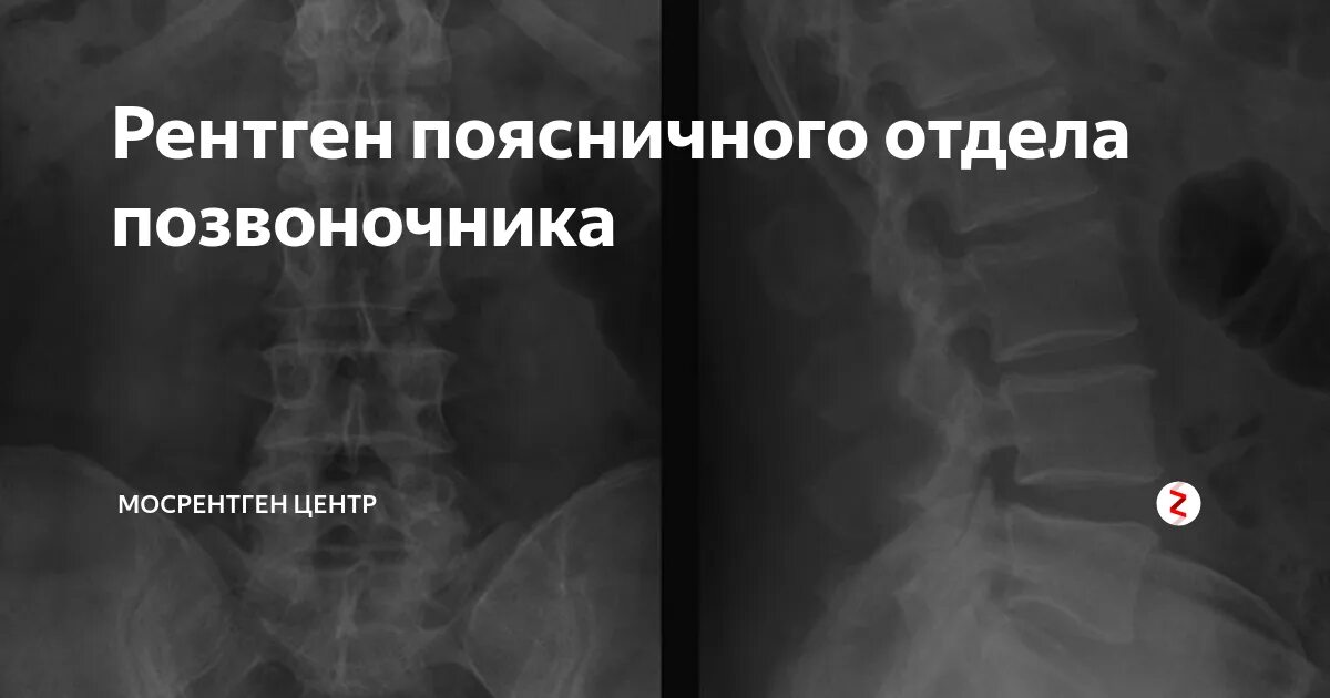 Рентген крестцового отдела позвоночника подготовка. Пояснично-крестцовый отдел позвоночника рентген норма. Функциональные пробы поясничного отдела позвоночника рентген. Рентген поясничного отдела позвонка. Функциональные рентгенограммы поясничного отдела позвоночника.