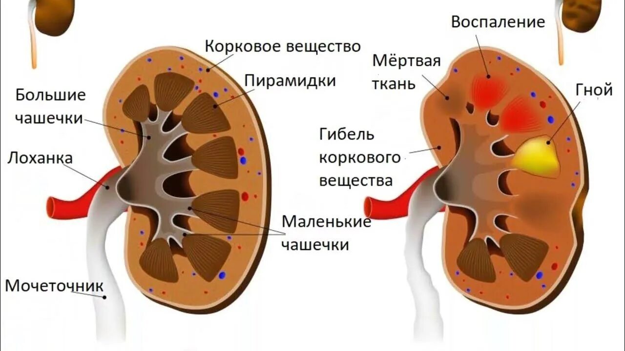 Воспаление почек заболевание. Что такое пиелонефрит почек лоханки. Почка пораженная пиелонефритом. Строение почки пиелонефрит. Болезни почек в разрезе.